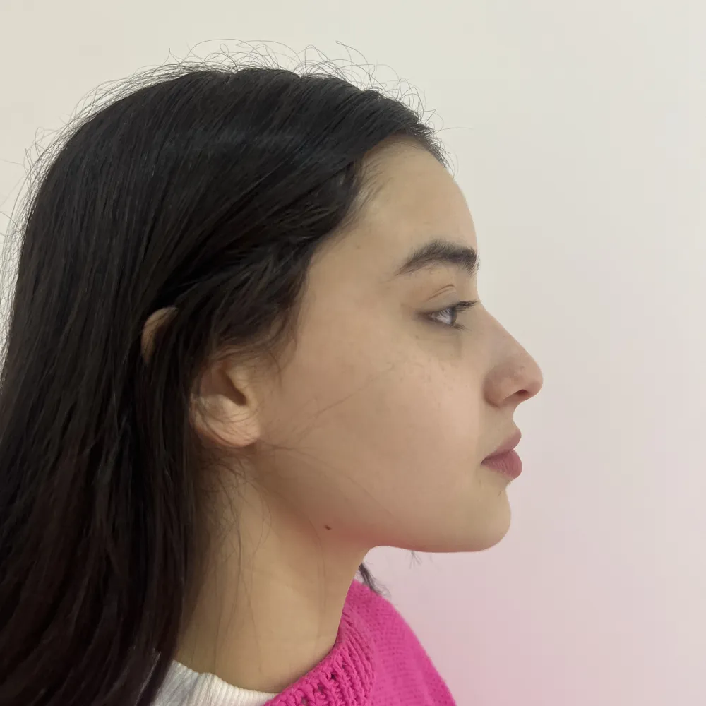 Perfil lateral de uma paciente antes da perfiloplastia, mostrando nariz, lábios e queixo