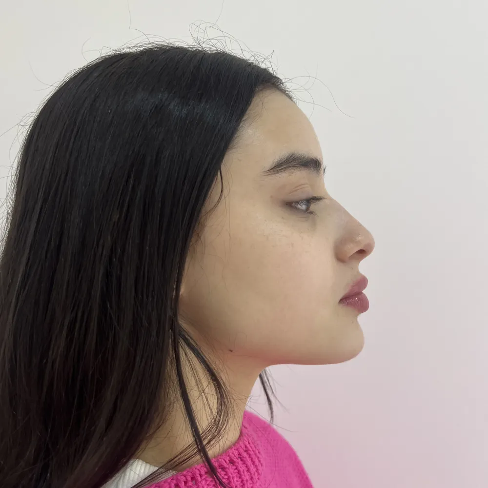 Perfil lateral da mesma paciente depois da perfiloplastia, mostrando nariz, lábios e queixo