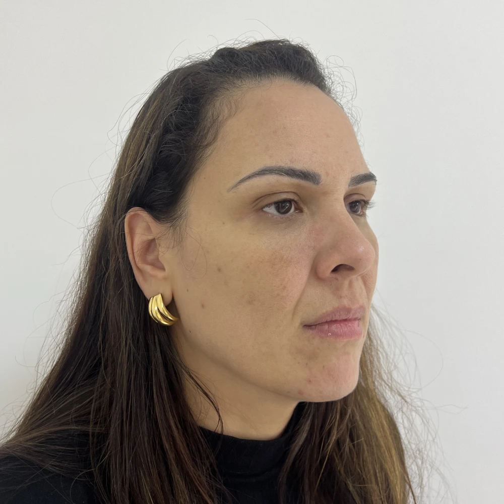 Rosto de uma paciente em vista de três quartos antes do preenchimento facial